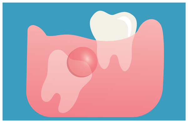 Wisdom Teeth Extraction in Hallandale