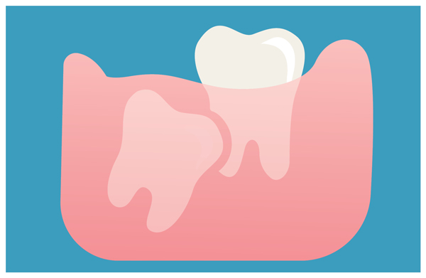 Wisdom Teeth Extraction in Miami