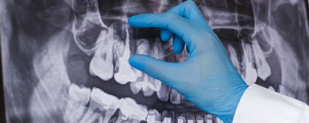 root canals treatment in miami