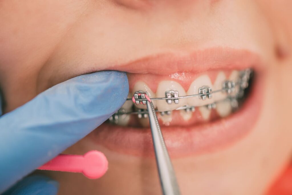 Traditional braces in Miami